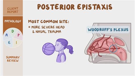 Epistaxis: What Is It, Types, Causes, Prevention,, 50% OFF