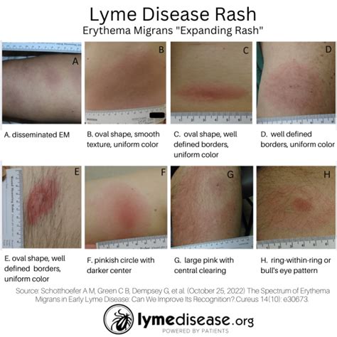 A Lyme rash doesn't always look like a bull's-eye target | LymeDisease.org