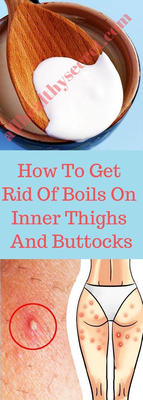 How To Get Rid Of Boils On Inner Thighs And Buttocks | Get rid of boils, Boils on buttocks, Boil ...