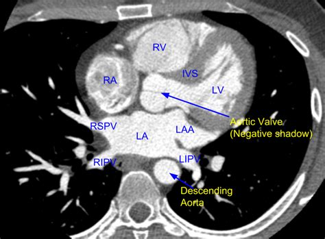 Cardiac CT - Pulmonary veins and left atrium