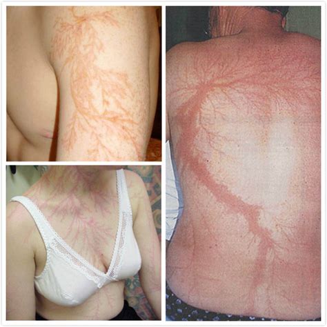 Lightning Scars on Body and Damages of Lightning Strikes | MedGuidance