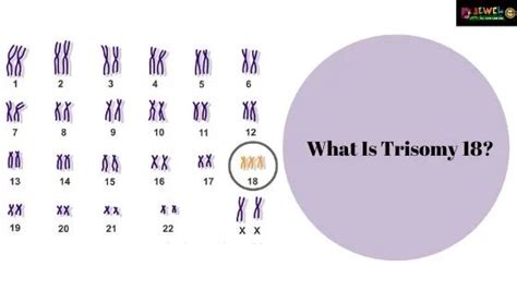 What Is Trisomy 18 | Edwards Syndrome | Types Of Trisomy 18