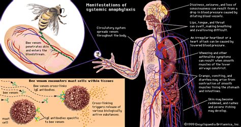 cardiovascular disease - Anaphylactic shock | Britannica