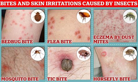Beware of Bed Bug Bites: How They Can Aggravate Mite Infestations ...