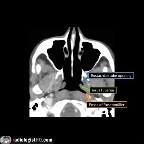 Nasopharyngeal Anatomy