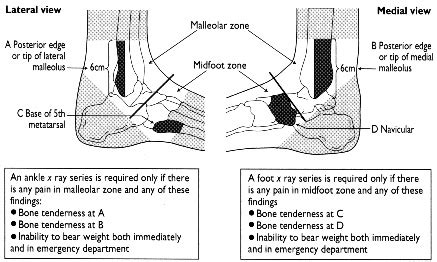 Multicentre trial to introduce the Ottawa ankle rules for use of ...