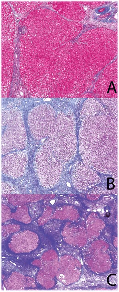 Laennec staging in cirrhosis. a Laennec stage 4A is characterized by... | Download Scientific ...