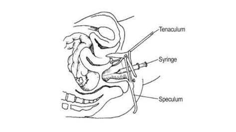 Culdocentesis