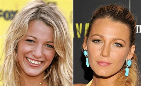 Blake Lively Plastic Surgery inspiration