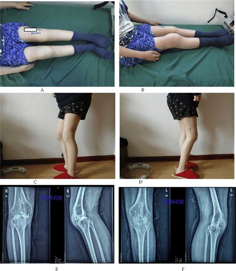 A-B: The case achieved full correction of knee flexion contractures,... | Download Scientific ...