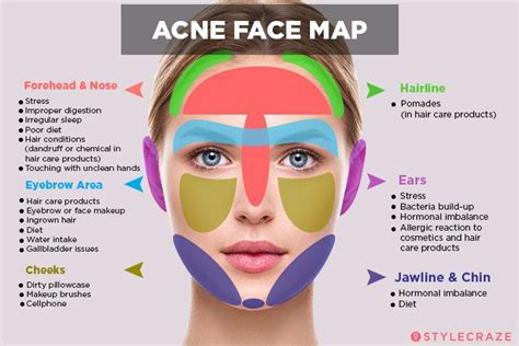 Acne Face Map: Is this for Real?