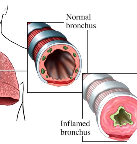 NUR326 Module 3: Asthma/COPD, Airway Inflammation, Bronchoconstriction Flashcards | Quizlet