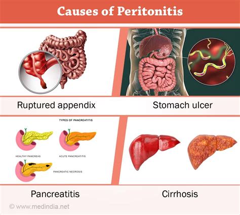 Peritonitis Causes Symptoms Diagnosis Treatment Complications | Images and Photos finder