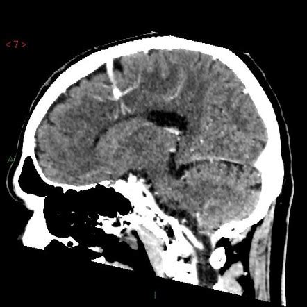 Developmental venous anomaly | Radiology Case | Radiopaedia.org