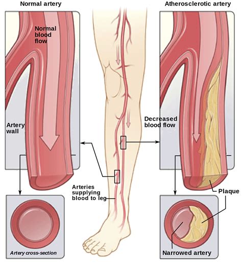 Peripheral Artery Disease - Causes, Symptoms & Treatment