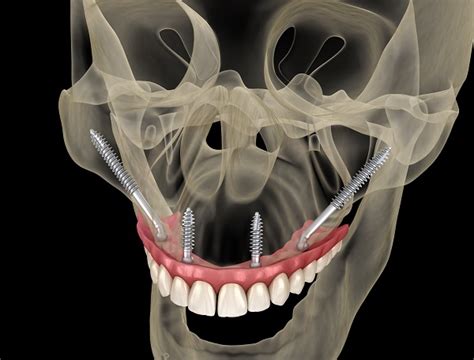 Implant Supported Dentures Procedure FAQs