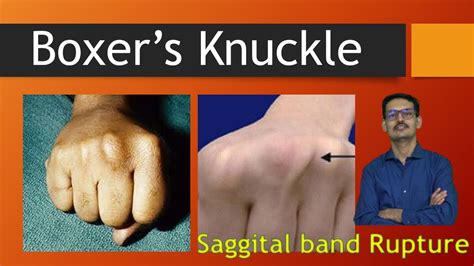 Boxer's Knuckle : Saggital Band Rupture in English - YouTube