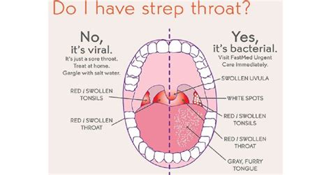 Swollen Tonsils With White Spots And Swollen Glands