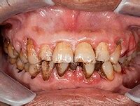 Surgery Costs More Than Scaling for Advanced Periodontitis