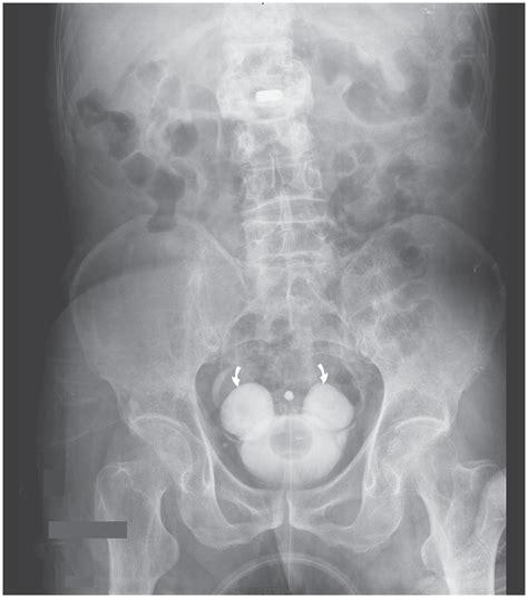 Bladder Diverticula | NEJM