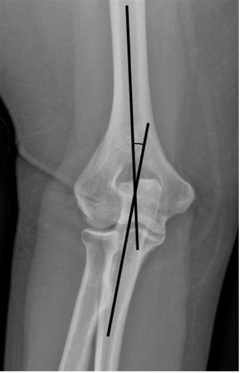 Cureus | Association Between Increased Elbow Carrying Angle and Lateral Epicondylitis