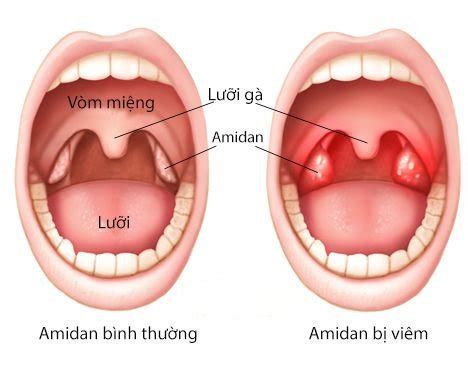 Viêm họng: Bệnh tưởng nhẹ nhưng chớ coi thường | Vinmec