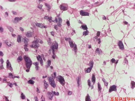 KMU Pathology Lab《Slide 150.》Liposarcoma, Soft tissue