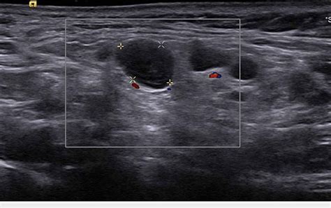 Ultrasound image of the supraclavicular area demonstrating hypoechoic... | Download Scientific ...