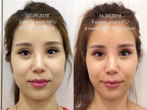 Can You Do Hifu After Fillers? | Justinboey