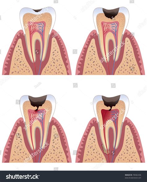 Diagram Of Tooth With Caries Stages Stock Vector Illustration 78582436 : Shutterstock