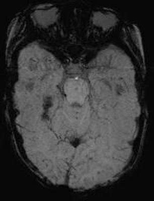 Neuroradiology On the Net: Capillary Telangiectasia