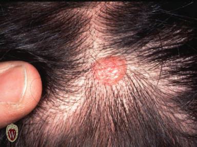melanoma on scalp pictures - pictures, photos