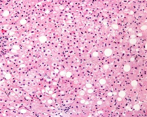 Human liver. Steatosis stock photo. Image of photomicrograph - 242799130