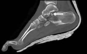 Subtalar Dislocations - Trauma - Orthobullets