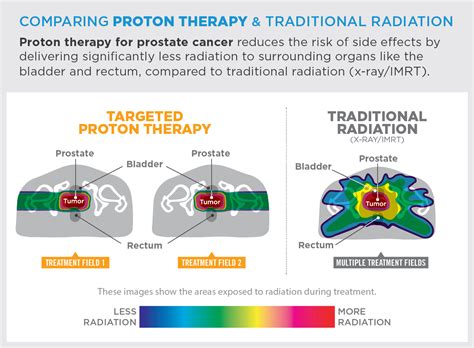 Prostate Cancer Treatment – Provision CARES Proton Therapy Knoxville