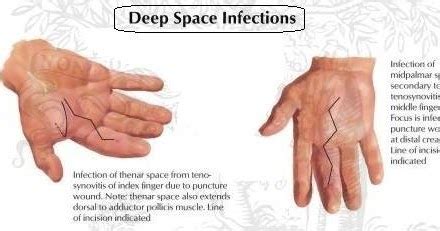 Hand infection