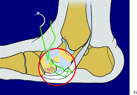 Talipes Calcaneovalgus | Semantic Scholar