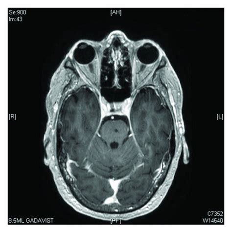 Posttreatment axial MRI image of the pons with complete ablation of the ...