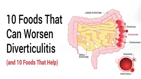 10 Foods That Can Worsen Diverticulitis (and 10 Foods That Help) in ...