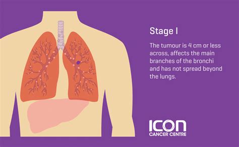 Lung Cancer Types & Stages | Icon Cancer Centre Singapore