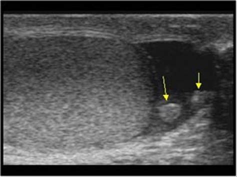 Urinary Tract and male reproductive system | 2.3 Scrotum : Case 2.3.1 Appendages and ...