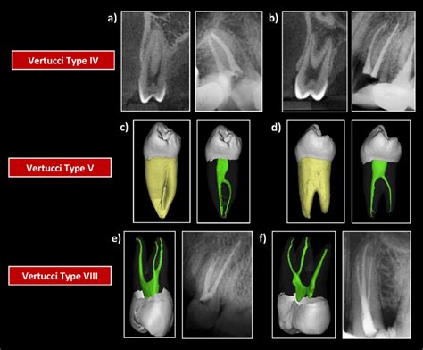 Tooth, Root, and Canal Anatomy | Pocket Dentistry