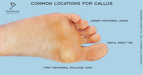 Diagnosis, Causes and Treatment of Callus - MASS4D® Insoles and Foot Orthotics