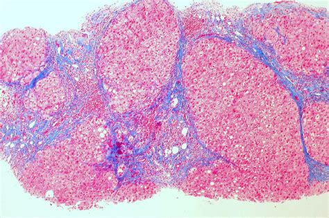 Cirrhosis of the liver (trichrome stain) | Cirrhosis, Vitamin d ...