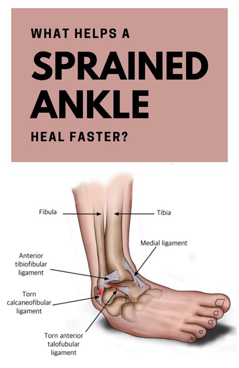 What Helps A Sprained Ankle Heal Faster | Sprained ankle, Sprained ankle remedies, Ligament tear