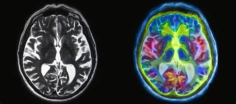 fMRI vs. SPECT Scan for the Brain | Cognitive FX