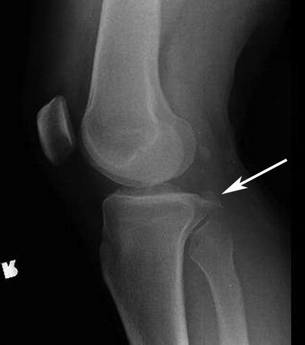 Avulsion Fracture X Ray - If people think that they may have a broken bone, they should go or be ...