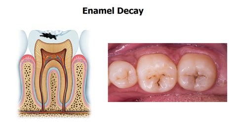 The 5 Stages of Tooth Decay | News | Dentagama