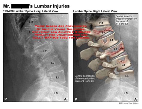 AMICUS Illustration of amicus,injury,lumbar,spine,injuries,vertebrae,X ...