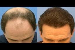 Biofibre Hair Transplant in Islamabad, Rawalpindi & Pakistan | Cost